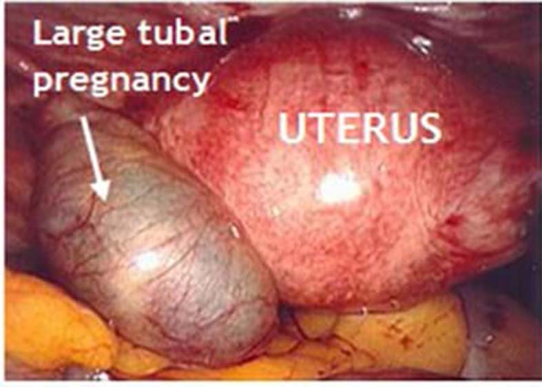 Case Of Ectopic Pregnancy