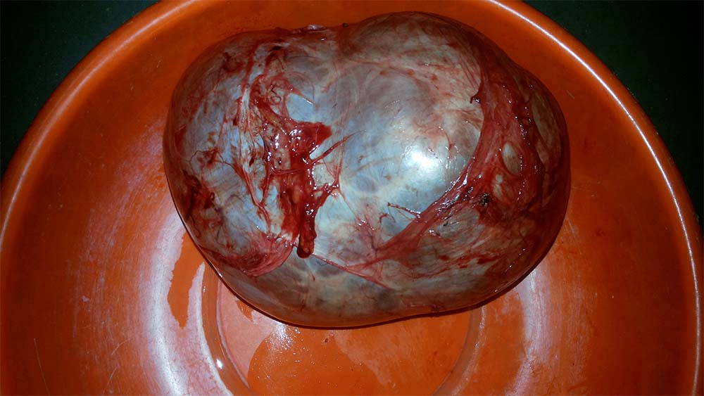 This Is Another Case Of Ovarian Tumour