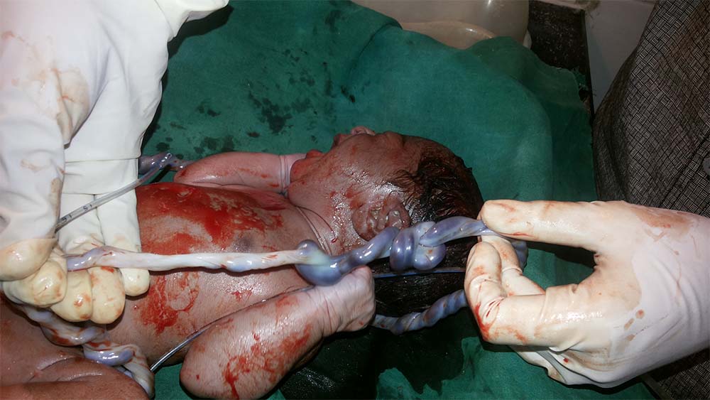 Case Of True Knot Of Umbilical Cord